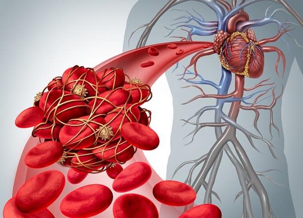 obstrução arterial aguda