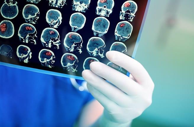 médico avaliando ressonância de paciente com acidente vascular cerebral