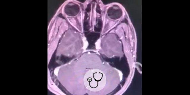 imagem de cistos coloides