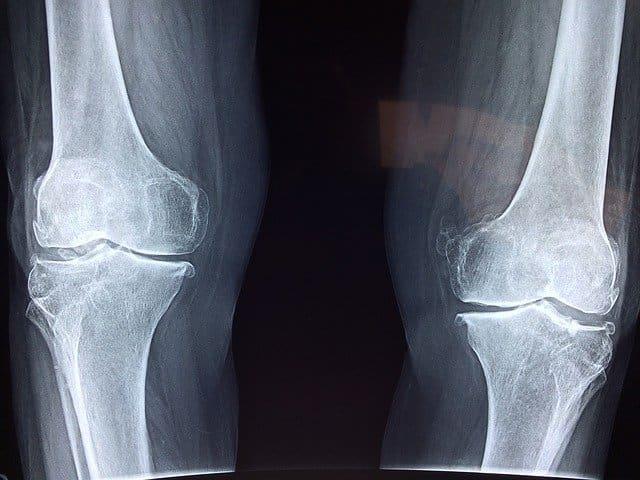 A cirurgia de artroplastia total do joelho (ATJ) envolve cortes ósseos precisos para remoção das superfícies acometidas pela degeneração articular, possibilitando assim o adequado implante dos componentes protéticos.