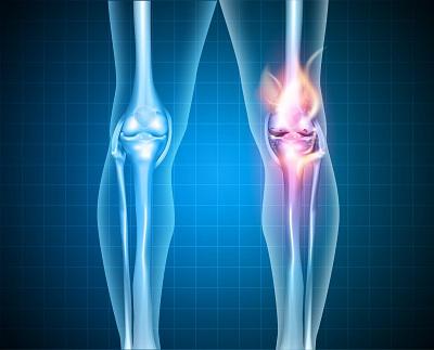 Osteoartrite de joelho infiltração com ácido hialurônico vs plasma rico em plaquetas 