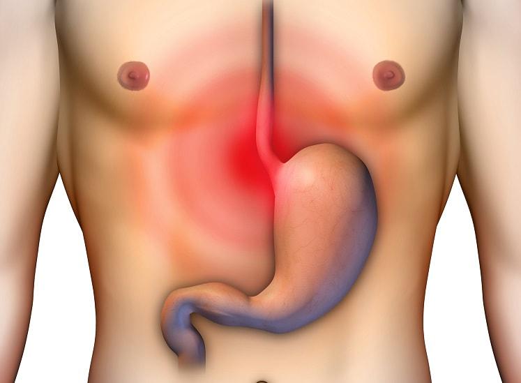 Atualização do manejo da Doença do Refluxo Gastroesofágico Refratária