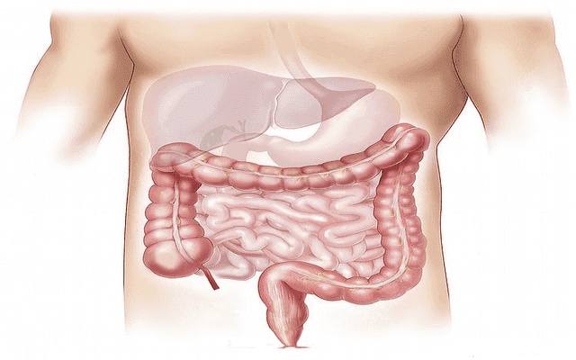 doenças inflamatórias intestinais