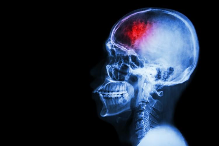 Anticoagulantes na trombose venosa cerebral