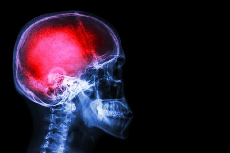 10 recomendações da nova diretriz para hemorragia cerebral intracraniana espontânea pela AHA/ASA