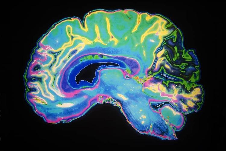 Perspectiva sobre trombectomia mecânica no AVC agudo com grande área de infarto