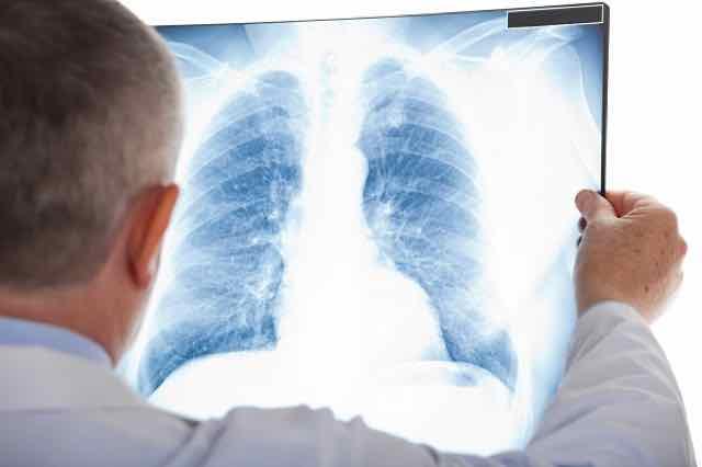 Pneumonia comunitária em pacientes imunocomprometidos