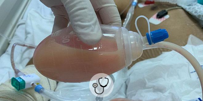 Caso clínico: homem com alteração no dreno após transplante hepático