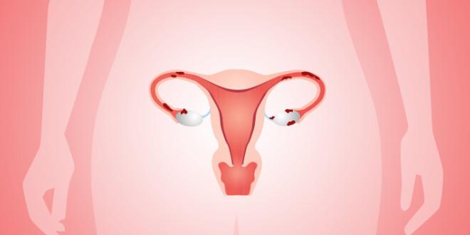 Síndrome dos Ovários Policísticos