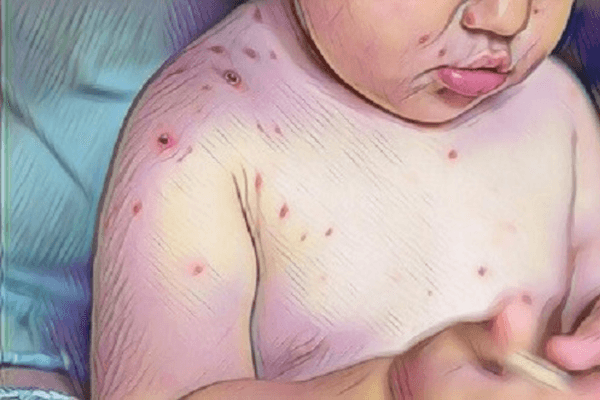 Monkeypox em crianças e adolescentes