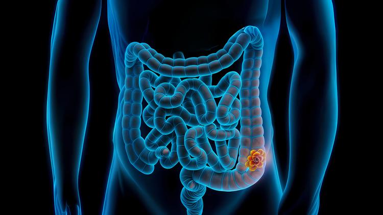 As novas diretrizes de polipose adenomatosa hereditária colorretal reunem critérios para teste genético, vigilância endoscópica, cirurgia e quimioprevenção