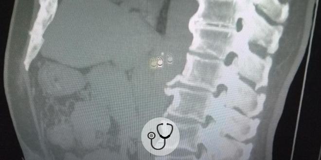 tomografia abdominal