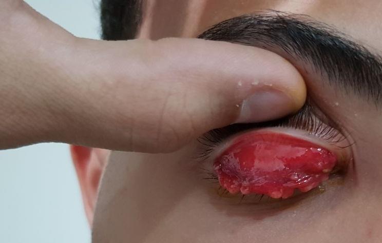 Foto dos efeitos da síndrome oculoglandular de Parinaud