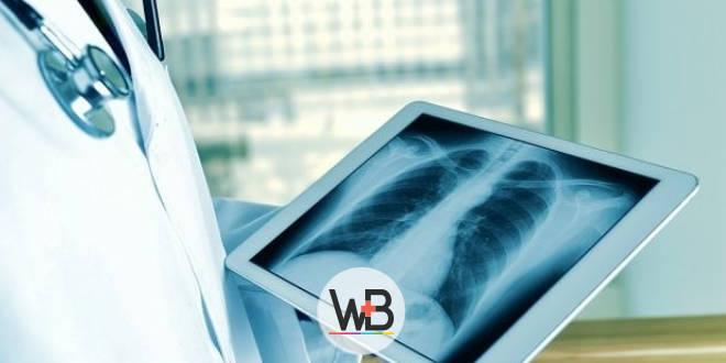 pneumonia comunitaria