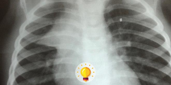 radiografia de torax de lactente
