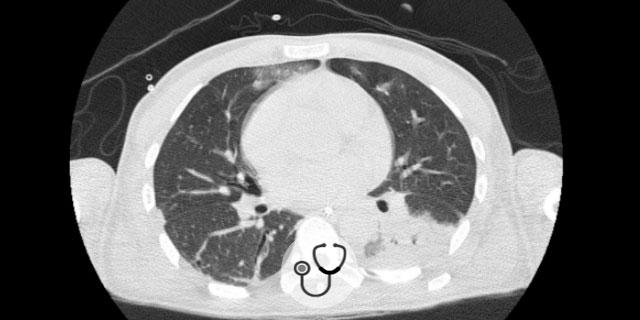 Caso clínico de paciente elitista com infecção por pneumococo
