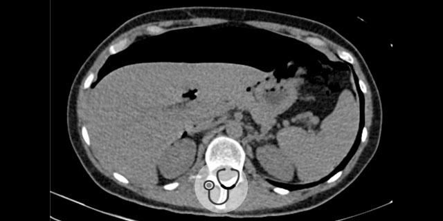 imagem tomográfica de complicação após colonoscopia