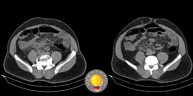 imagem tomográfica de paciente com dor abdominal