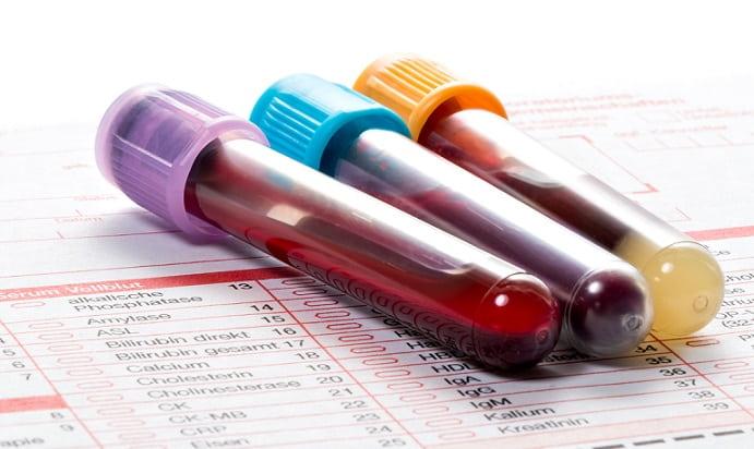 frascos de sangue de paciente com acromegalia