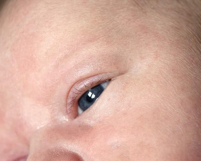 Profilaxia da conjuntivite neonatal