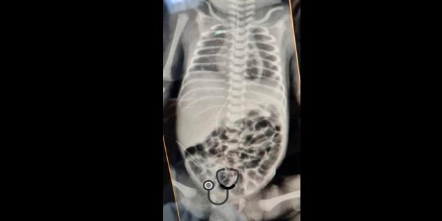 RN com 2 dias de vida, prematuro de 32 semanas, gemelar, com dieta trófica + NPT em cpap nasal apresenta parada cardíaca.