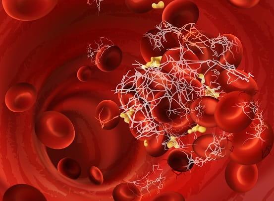Profilaxia e tratamento de tromboembolismo venoso nos pacientes oncológicos