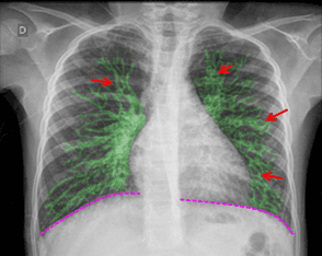 Bronquiectasias: diagnóstico e manejo