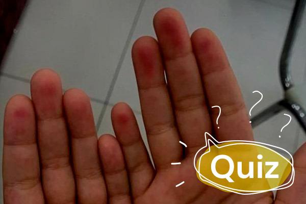quiz manchas erimatosas