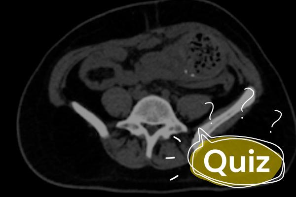 Quiz: Paciente de 36 anos com dor abdominal na fossa ilíaca esquerda. Qual o diagnóstico?