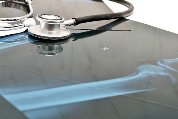 fraturas de escafoide