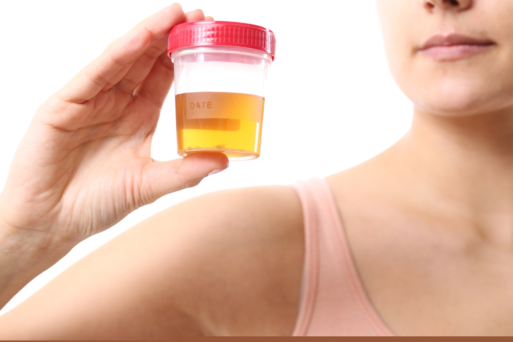 Orientações ao paciente: como evitar a contaminação da amostra na cultura de urina?