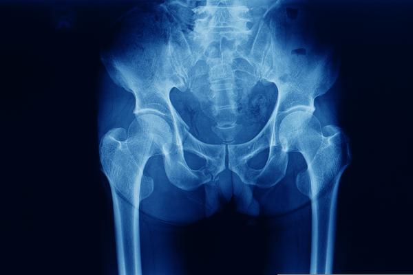 Hastes cefalomedulares longas ou de tamanho padrão nas fraturas do quadril?