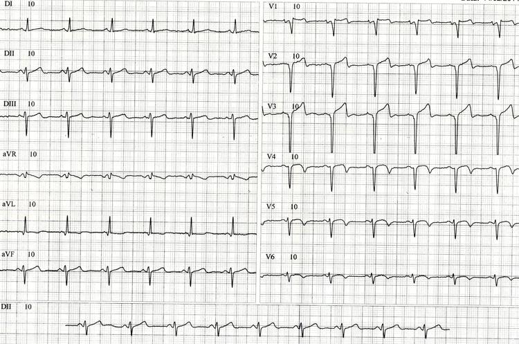 IAM com supra de ST tem ficado menos frequente nos últimos anos?