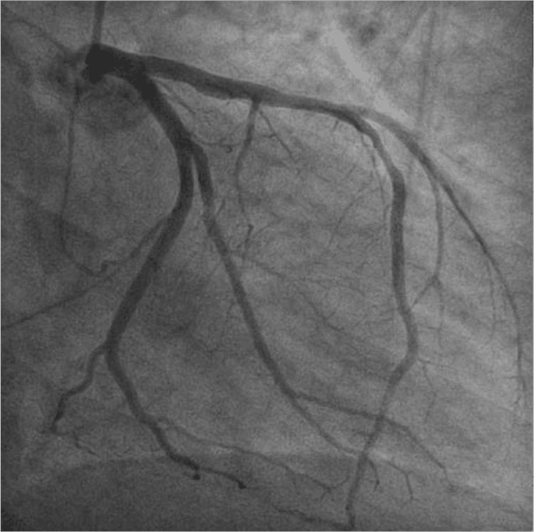Trabalhos clássicos de dislipidemias: AFCAPS/texCAPS