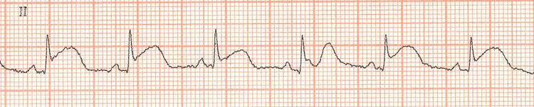 Vale a pena angioplastar lesões não culpadas em pacientes com IAM com supra de ST?