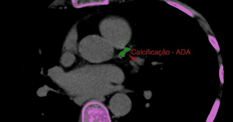 Qual a prevalência de coronariopatia subclínica na população?