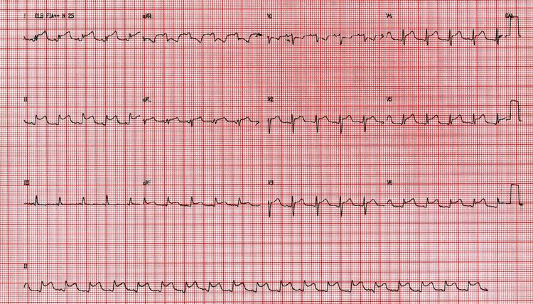 ¿Cuál es el examen complementario patrón oro para el diagnóstico de pericarditis aguda?