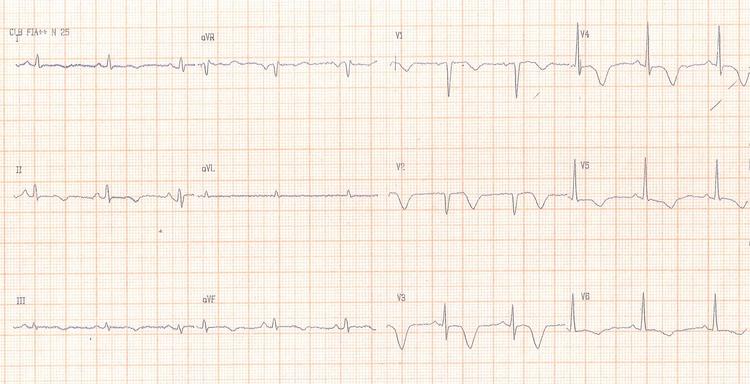 Curso básico de eletrocardiograma – parte 16 – Onda T
