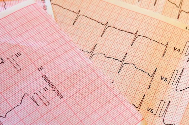 Quais os critérios de Sokolow