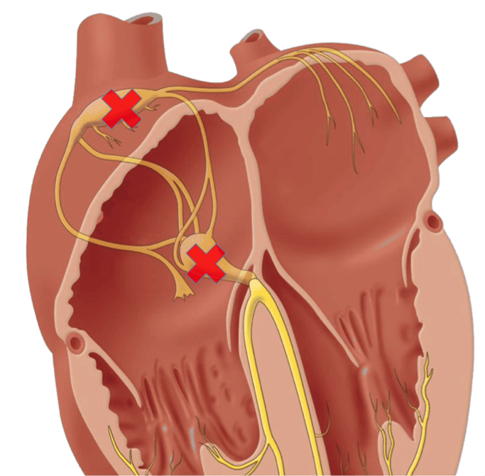 diferentes bloqueios atrioventriculares