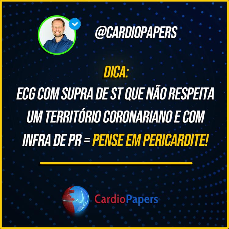 ECG com supra ST que não respeita parede e com infra PR - pense em Pericardite!