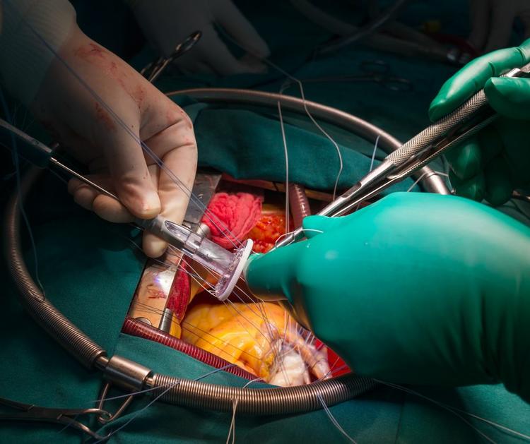 Paciente vai para cirurgia de revascularização miocárdica e tem IM secundária: vale a pena mexer na mitral?