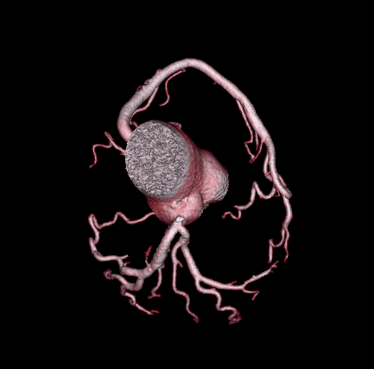 Cuál es el futuro de la ANGIOTOMOGRAFIA DE CORONARIAS?