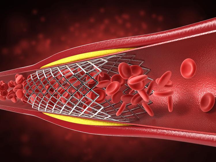 La importancia del control agresivo de LDL después de la angioplastia coronaria