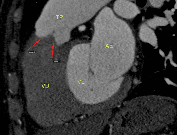 Qual a causa do sopro dessa paciente? Consegue acertar essa angiotomografia?