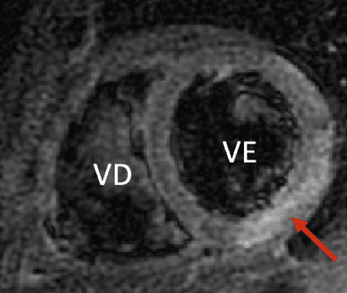 A Ressonância Cardíaca é capaz de determinar injúria miocárdica aguda?