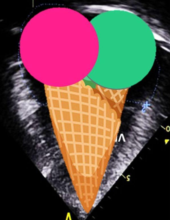 POCUS: Você conhece o sinal do "Sorvete Duplo de Casquinha" ?