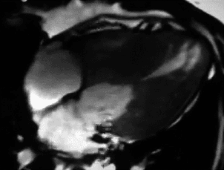 EXPLORER-HCM: mavacamten para pacientes con MCH obstructiva!
