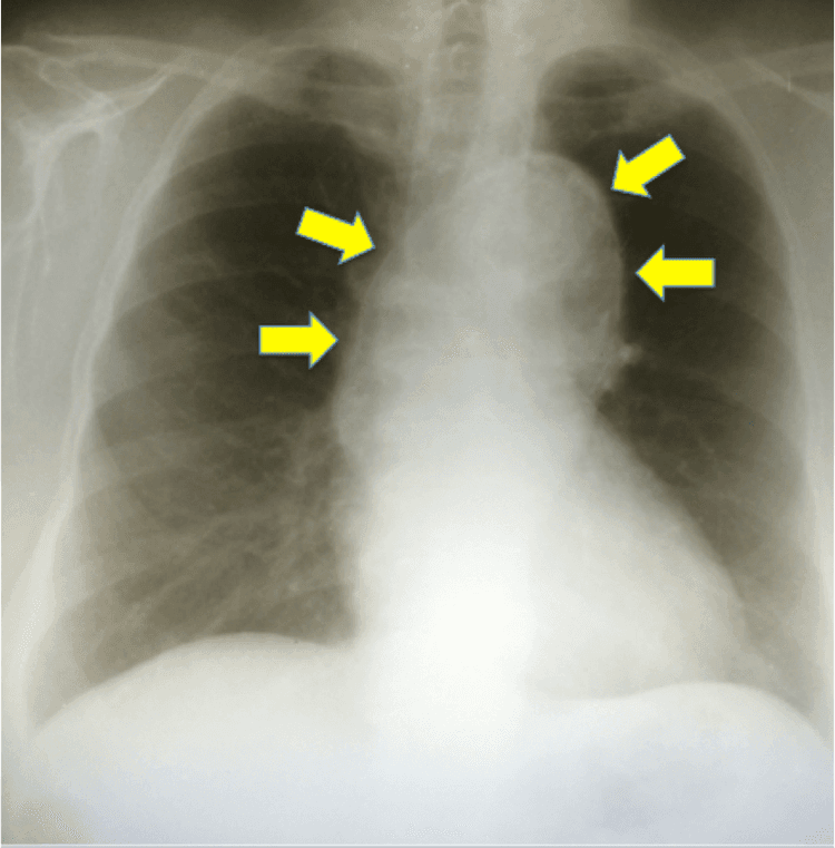 Você pede tc de tórax para pacientes que irão fazer revascularização miocárdica?