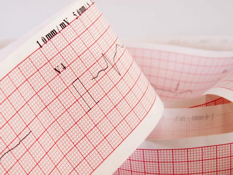 Como definir se o ritmo do ecg é sinusal?